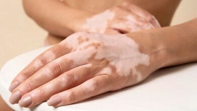 آخرین نکات پزشکی برای کنترل لکه های پوستی - آژانس خبری مهر | اخبار ایرانی و جهانی