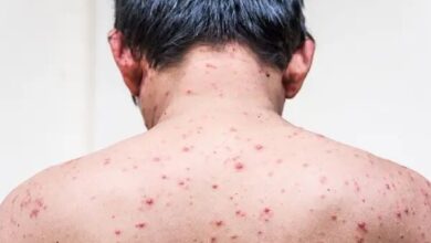 آبله در بزرگسالان ؛ عوارض شدیدتر و خطرناک تر از کودکان