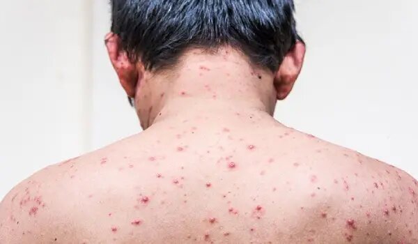 آبله در بزرگسالان ؛ عوارض شدیدتر و خطرناک تر از کودکان