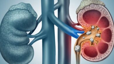 اعتقادات دروغین در مورد سنگ های ادرار/ راهکارهای پیشگیری