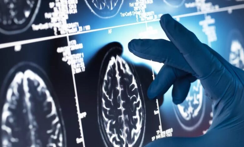 یک داروی گیاهی مفید علیه آلزایمر