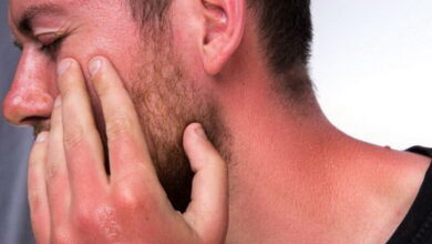 آفتاب سوختگی و گرمای فصل برای پوست