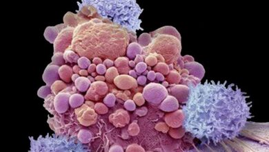 چگونه سوکلها می توانند ایمونوتراپی سرطان را مختل کنند؟