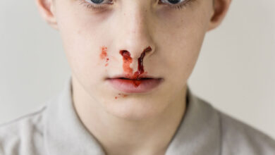 بینی خونریزی از علل تا علت عدم کنترل خونریزی