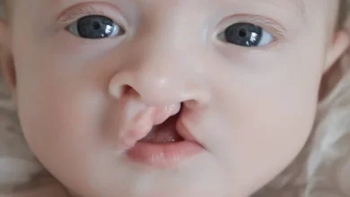 پیشگیری از شکاف لب و کام ؛ معرفی بهترین و مؤثرترین روش ها - دکتر اکبری