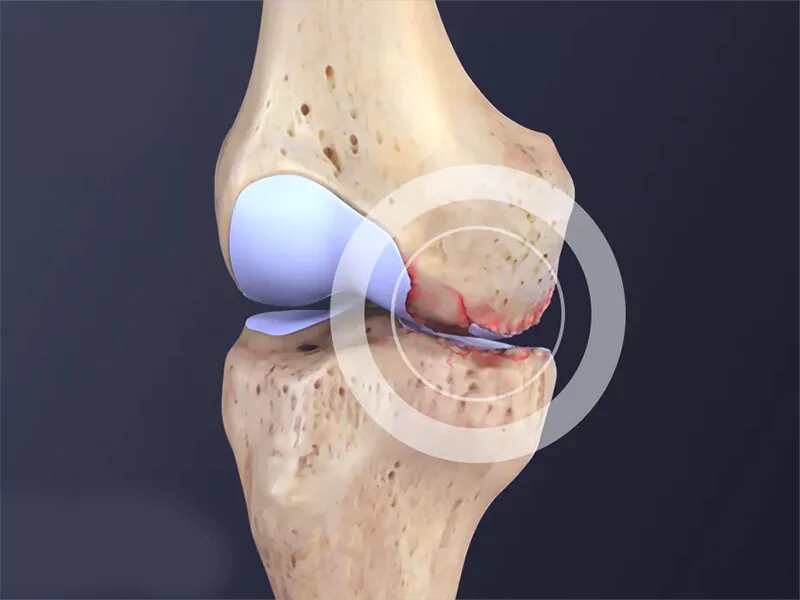 آرتریت زانو ؛ از سن تا ژنتیک و شرایط شغلی