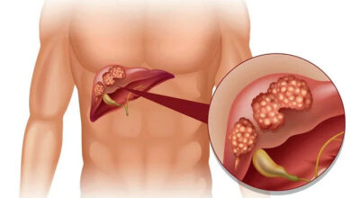 عادت هایی که احتمال ابتلا به سرطان کبد را افزایش می دهد