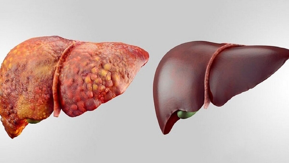 علائم کم آبی چیست و درمان چیست؟