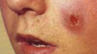 شانه ها و شانه های لیشمانیا