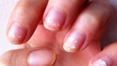 روش تشخیص کم خونی از پوست دست