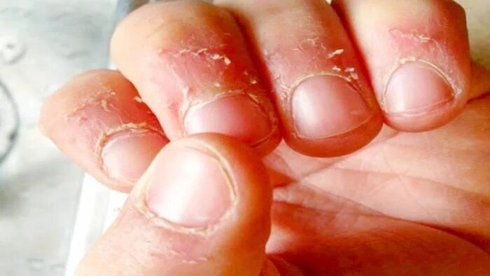 علت پوست پوست در اطراف ناخن و روشهای درمانی