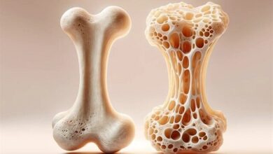 آیا می دانید کمبود این ویتامین ها استخوان ها را شکننده می کند؟