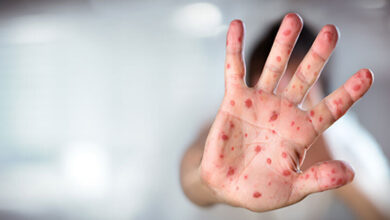 زنگ هشدار "سرخک" در شمال کشور - آژانس خبری مهر | اخبار ایرانی و جهانی