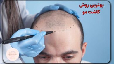 بهترین روش‌های کاشت مو در ایران؛ مزایا، معایب و نکات کلیدی پیش از اقدام
