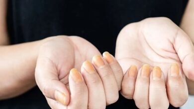 ناخن زرد علامت چیست؟