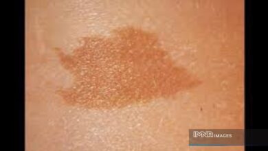 علت گرفتگی روی بدن کودک چیست؟ | از گرفتگی واقعی جلوگیری می کند؟