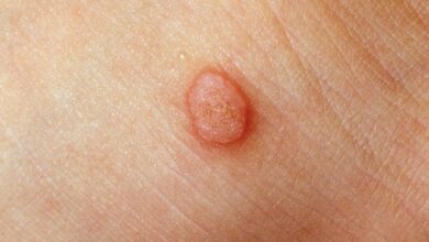 تفاوت بین گوشت و زگیل چیست؟