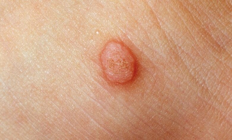 تفاوت بین گوشت و زگیل چیست؟