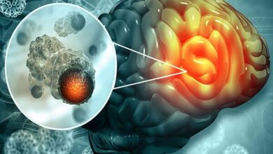 اولین عمل جراحی پیشرفته هیپوتالاموس را برای کودک ایرانی انجام دهید - آژانس خبری مهر | اخبار ایرانی و جهانی