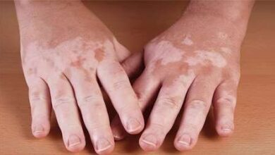 دوباره بیماری پسی/ روشهای درمانی