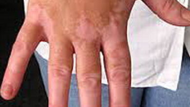 توصیه های مهم در مورد این بیماری پوستی