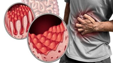 بیماران مبتلا به سلیاک باید از گلوتن - آژانس خبری Mehr | اخبار ایرانی و جهانی