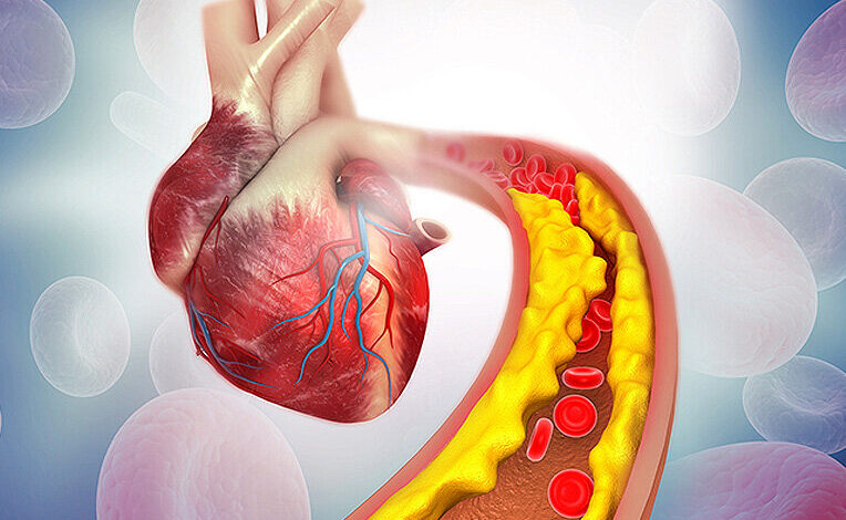 راه حل های ساده در خانه برای کاهش کلسترول