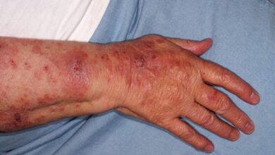 بیماری سلیاک چیست؟/ علائم و علائم