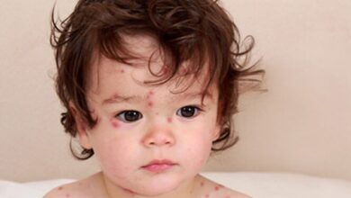 چه کسانی واجد شرایط تزریق واکسن آبله مرغان هستند؟