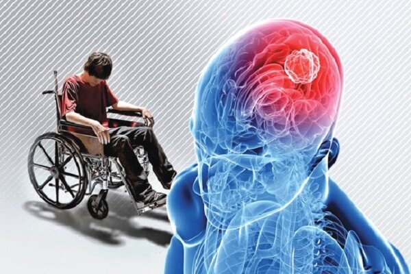 ام‌اس؛ بیماری جوانان با 2 علائم ساکت