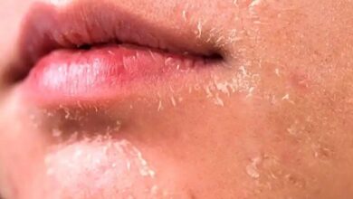 خشکی پوست در پاییز + علت ، علائم و راهکارهای پیشگیری