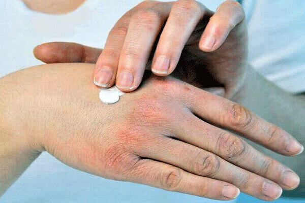 استراتژی های ساده برای جلوگیری از خشکی پوست در پاییز
