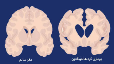 درمان موفقیت آمیز یک بیماری سخت برای اولین بار