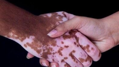 راهی برای کاهش لکه های پوستی در ایران