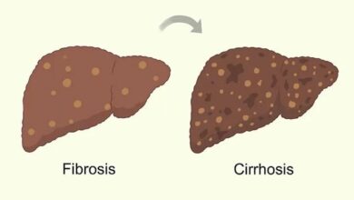آیا باید از کبد چرب بترسید؟/ آنزیم های کبد طبیعی ، هیچ نشانه ای از کبد چرب وجود ندارد؟