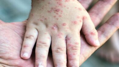 مرگ نوزاد در کانادا به دلیل سرخک در میان شیوع - آژانس خبری مهر | اخبار ایرانی و جهانی