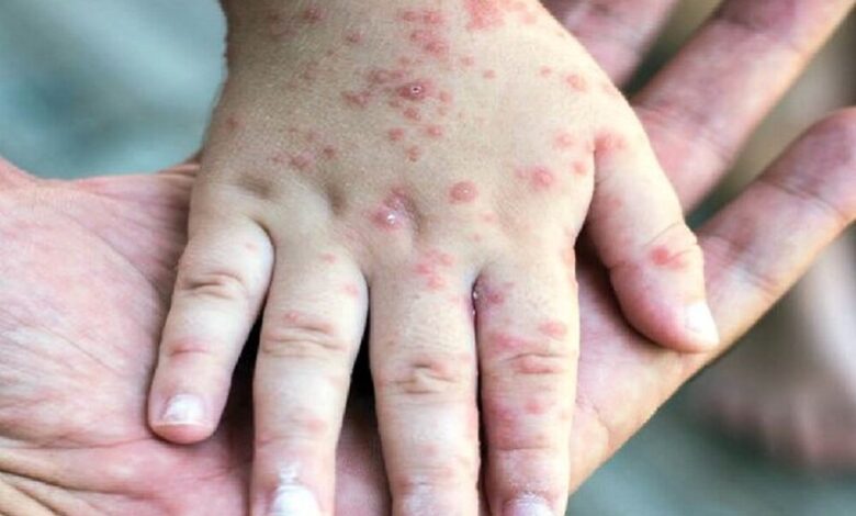 مرگ نوزاد در کانادا به دلیل سرخک در میان شیوع - آژانس خبری مهر | اخبار ایرانی و جهانی