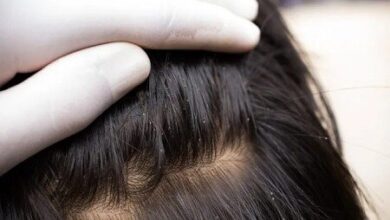 سعادت اروپا و کودکان در شمال شهر بیشتر درگیر شپش هستند!/ دلیل جالب برای یک متخصص