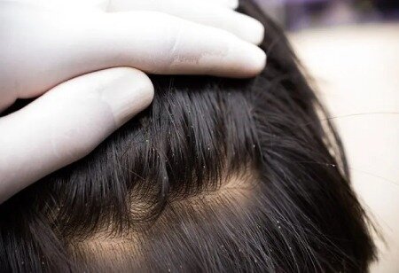 سعادت اروپا و کودکان در شمال شهر بیشتر درگیر شپش هستند!/ دلیل جالب برای یک متخصص