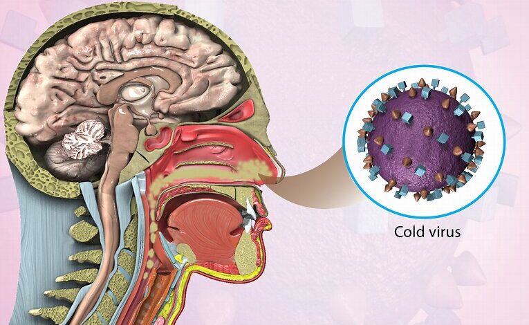 چگونه سکته مغزی از گرفتگی/ خلط بینی را درمان کنیم؟