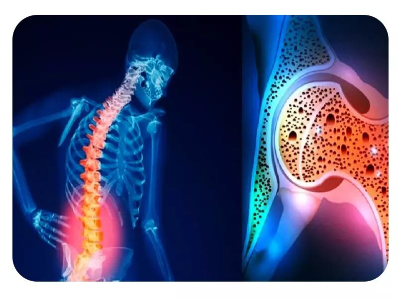 برای افزایش چگالی استخوان چه چیزی بخورید؟ 