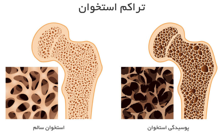 برای افزایش چگالی استخوان چه چیزی بخورید؟
