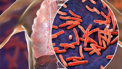 بیماری سل چیست و چرا هنوز هم مهم است؟ | ایران در مسیر از بین بردن آمار و چالش های سل