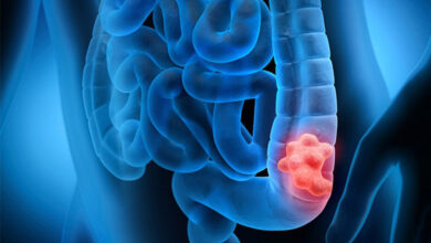 تادین: سن سرطان روده بزرگ در ایران کاهش نگران کننده ای دارد - آژانس خبری مهر | اخبار ایرانی و جهانی