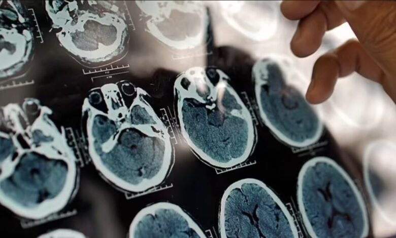 هشدار؛ کمبود این ویتامین ها در بدن منجر به زوال عقل می شود