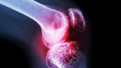 کاهش تراکم استخوان بعد از 30 سالگی / آیا پوکی استخوان قد را کوتاه می کند؟