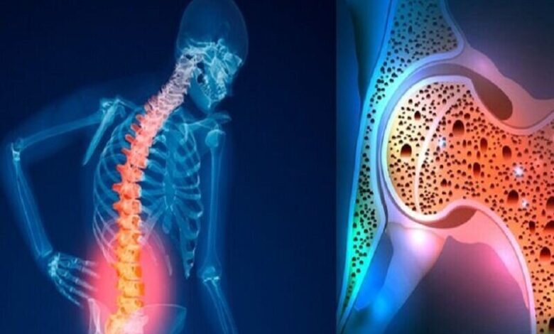 پوکی استخوان، یک چالش بزرگ بهداشت عمومی