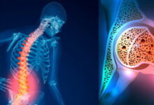 چرا مردم پوکی استخوان را بیماری نمی‌دانند؟