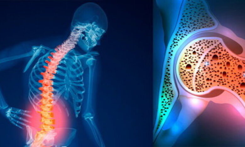 چرا مردم پوکی استخوان را بیماری نمی‌دانند؟