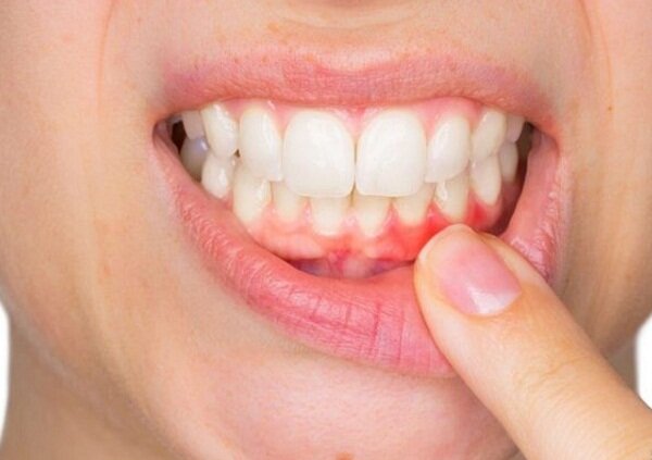 بایدها و نبایدهای التهاب لثه در دوران بلوغ